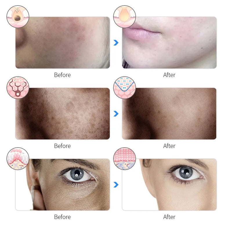 Máscara De Rejuvenescimento Facial De Led