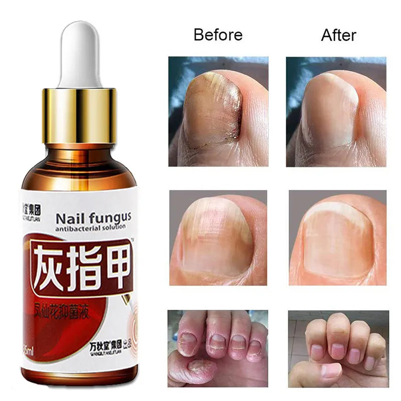 Removedor De Fungos Nail