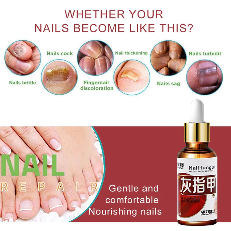 Removedor De Fungos Nail